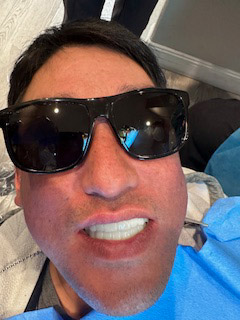 Before and After - Case 2